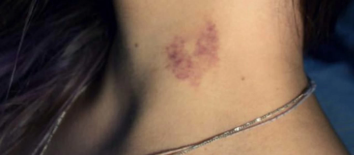 Τι να κάνετε για να... εξαφανίσετε την πιπιλιά στο λαιμό